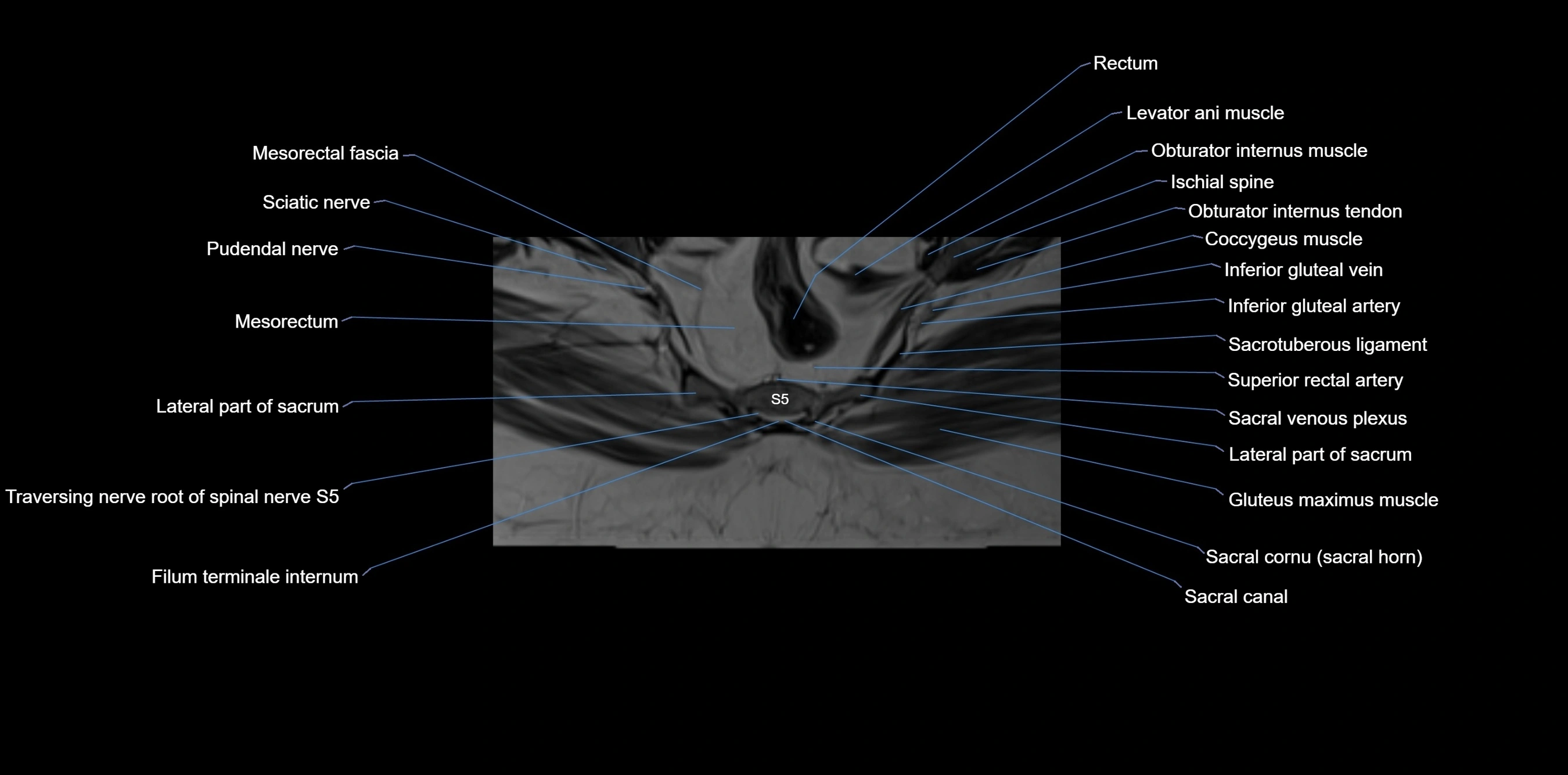 MRI sacrum, coccyx and sacroiliac joint axial cross sectional anatomy 3T  radiology  image-img-00001-00056.webp
